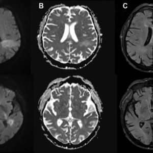 You're likely already infected with a brain-eating virus you've never heard of