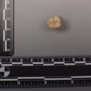 Protein in Homo erectus teeth suggests Denisovans gave us some of their DNA