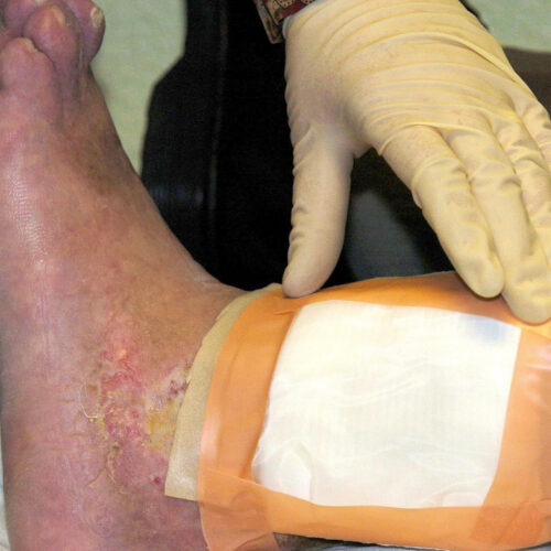Second carcass-eating fly species cleared by FDA for maggot wound therapy