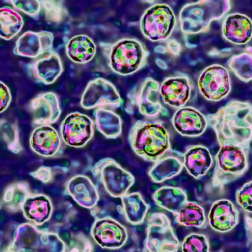 South Carolina's measles outbreak jumped to Washington state 5 times in 2 weeks